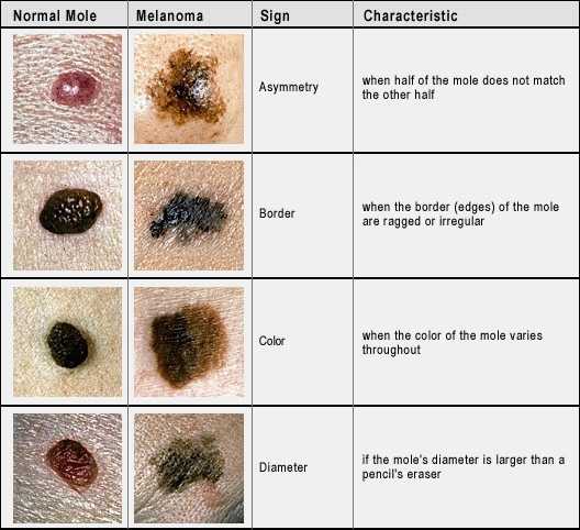 Signs of skin cancer
