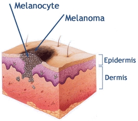 Melanoma